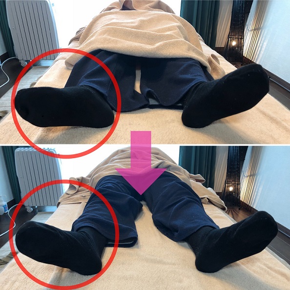 骨盤矯正後の改善例